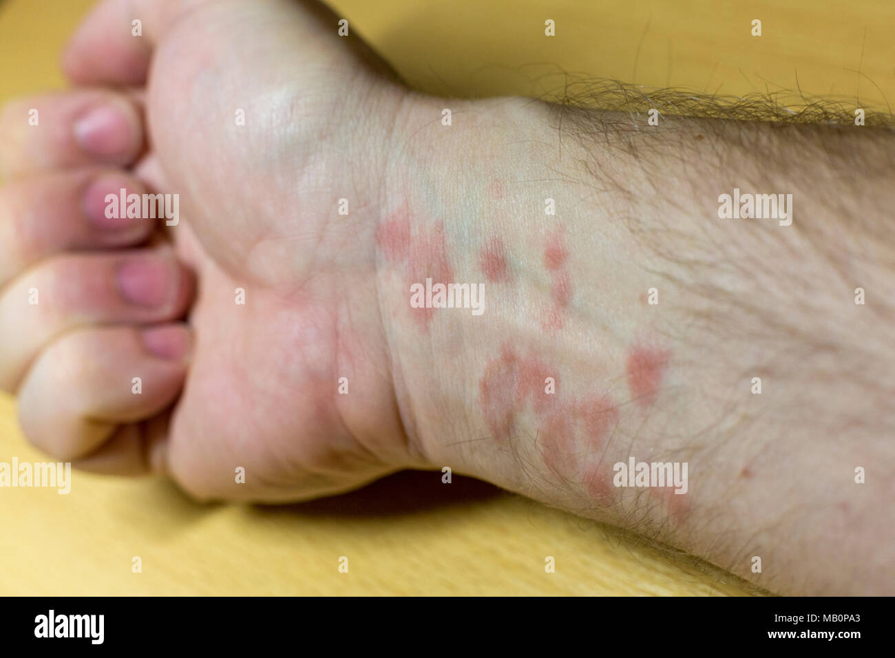 Vista dettagliata del rosso malattia infiammato macchie sulle mani di un  uomo Foto stock - Alamy