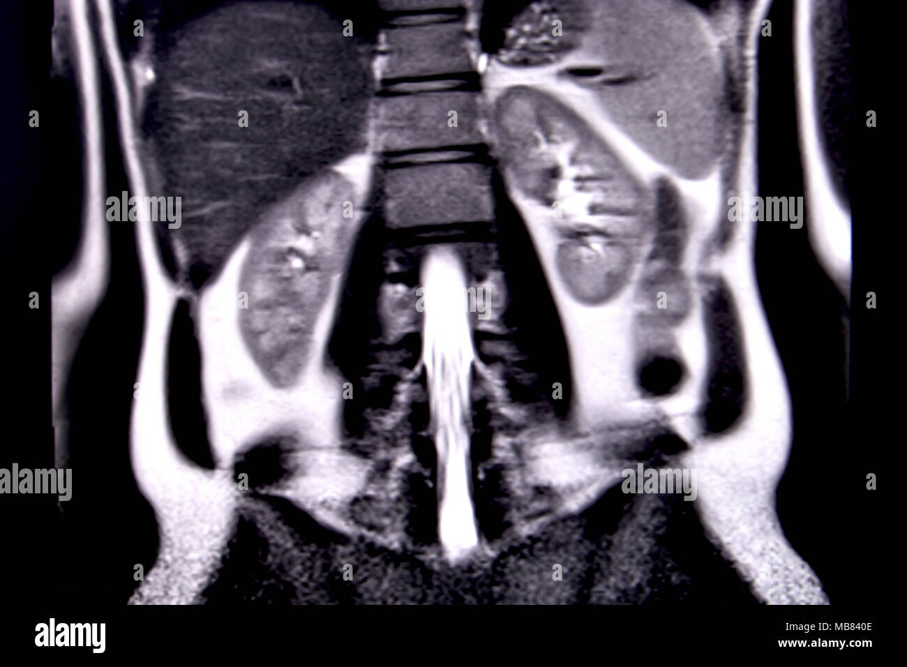 Viaggio attraverso l'addome umano e del torace mediante 18 tagli MRI (vista coronale). Immagine 11/18 Foto Stock