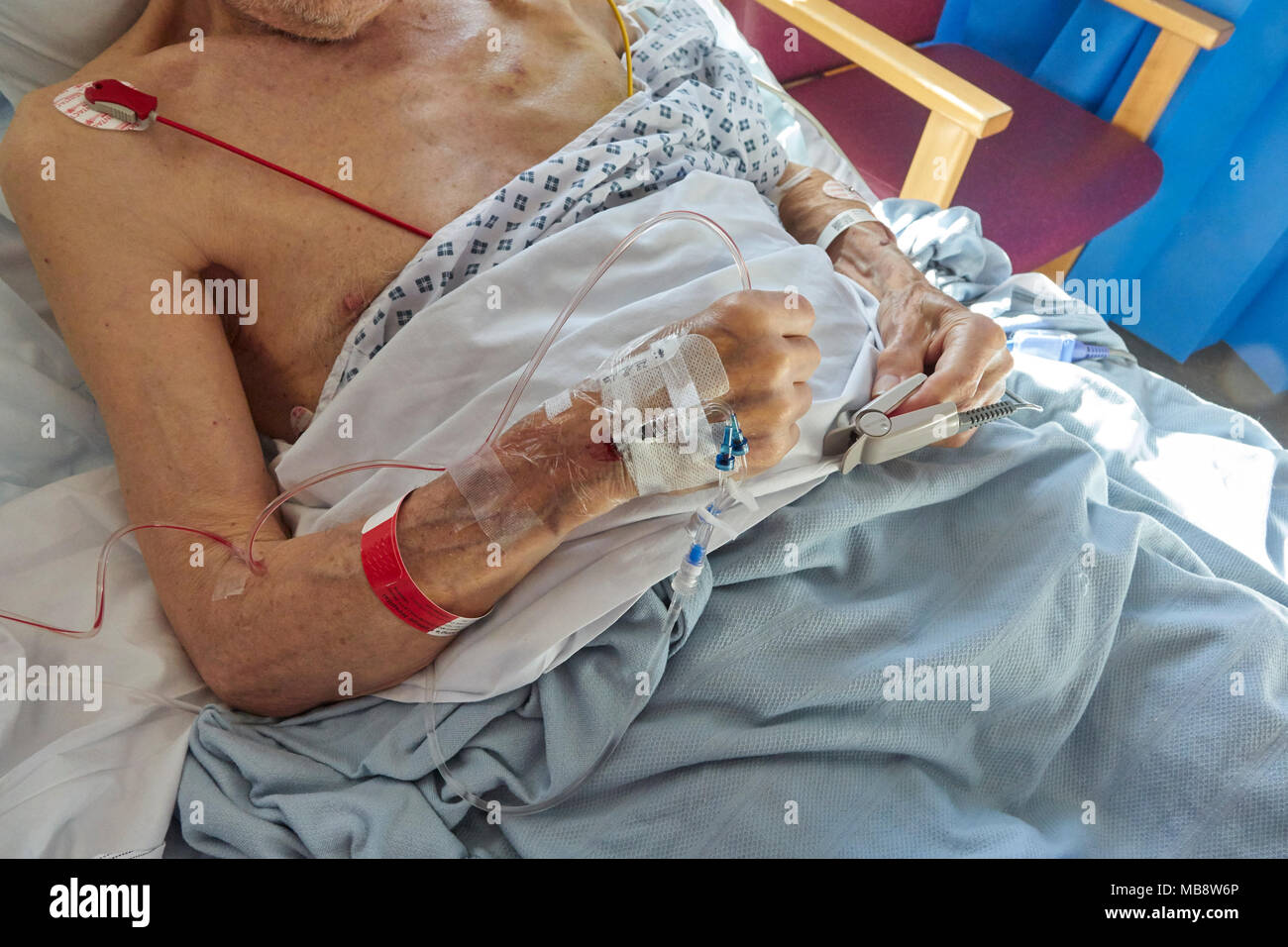 Paziente di sesso maschile il recupero dalla cardiochirurgia, London, Regno Unito Foto Stock