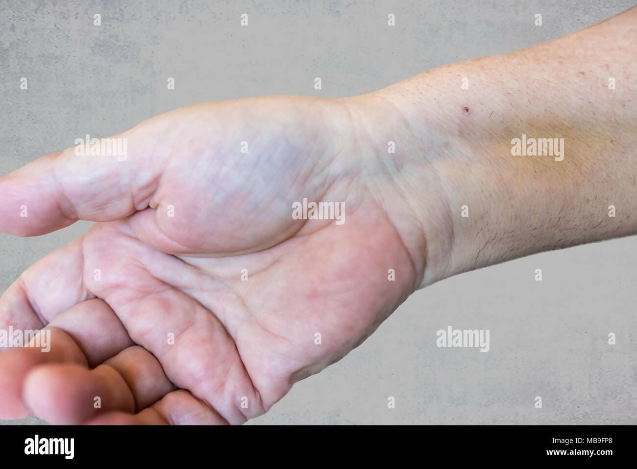 Un vecchio mano maschio con una traccia del punto dopo il passaggio attraverso un impianto di stent al cuore dopo un attacco di cuore. Foto Stock