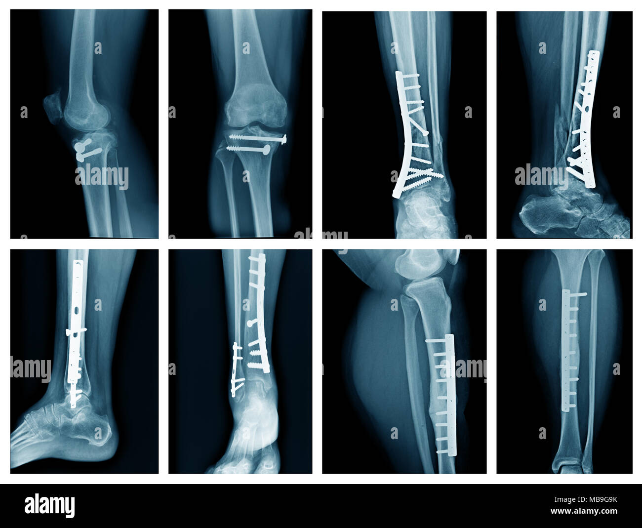 Collezione gamba x-ray con fissazione interna, alta qualità xray frattura della gamba con post operazione osso fix Foto Stock