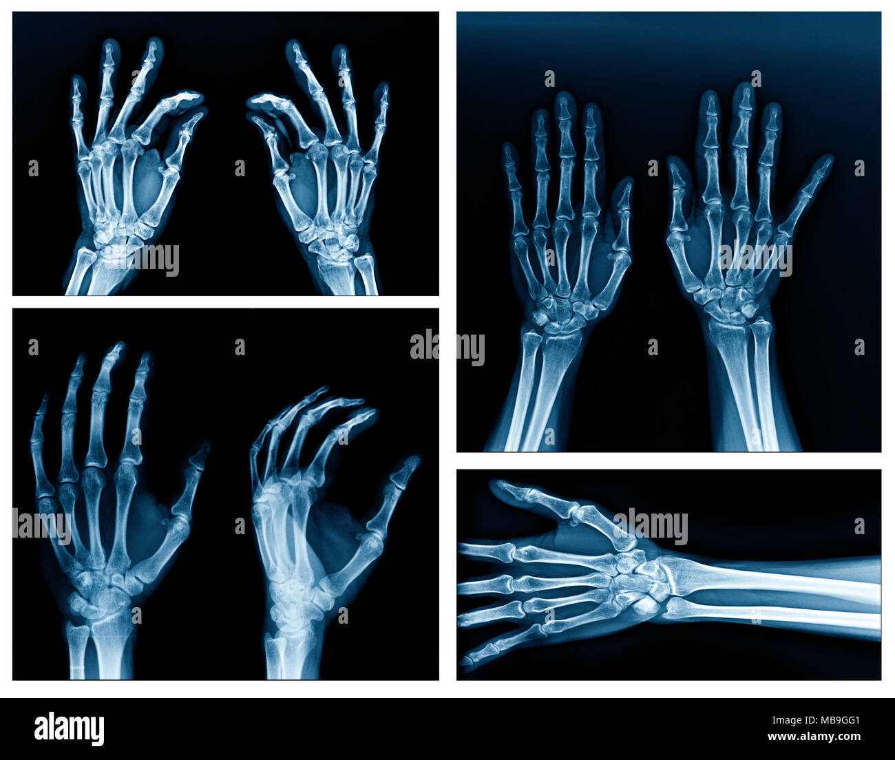 Mano di raccolta x-ray immagine ad alta qualità Foto Stock