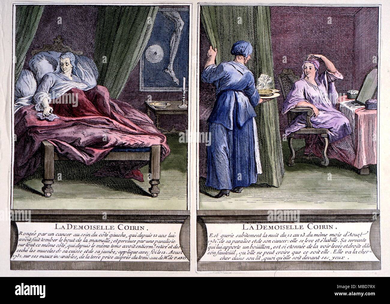 Strani fenomeni guarigione miracolosa di mlle Coirin dal Diacono di Parigi. L'immagine a sinistra shnowns Coirin languire nella malattia, che a destra mostra il suo miracolosamente guarito. da C. de Montgeron 'La Verite des miracles du Diacre Parigi, 1737 Foto Stock