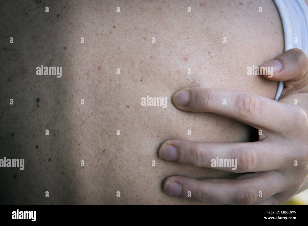 Le donne con la pigmentazione della pelle e un sacco di birthmarks Foto  stock - Alamy