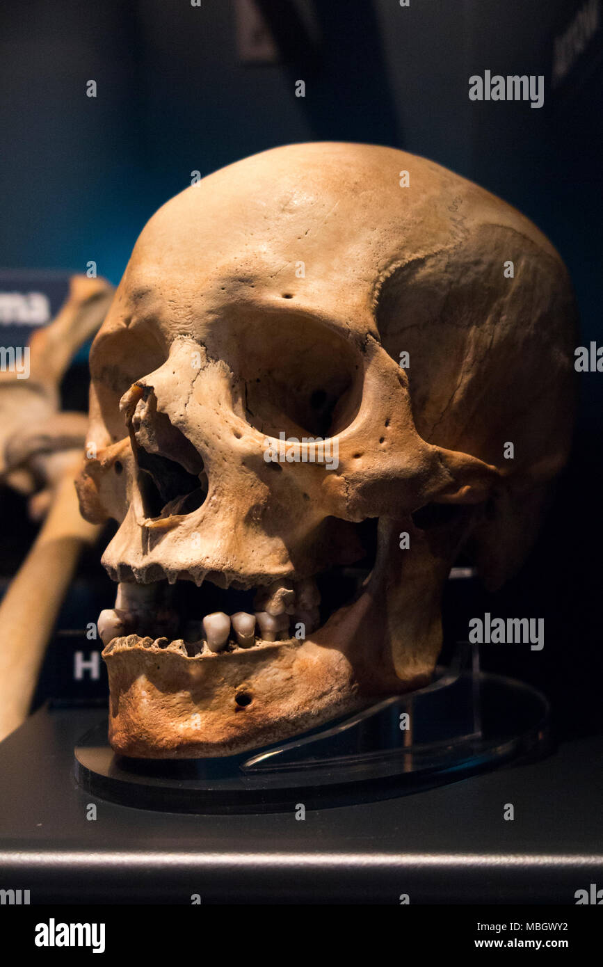 Cranio umano dal relitto della Mary Rose; nave da guerra di inglese Tudor marina del re Henry VIII Il Mary Rose Museum, Historic Dockyard, Portsmouth. Regno Unito Foto Stock