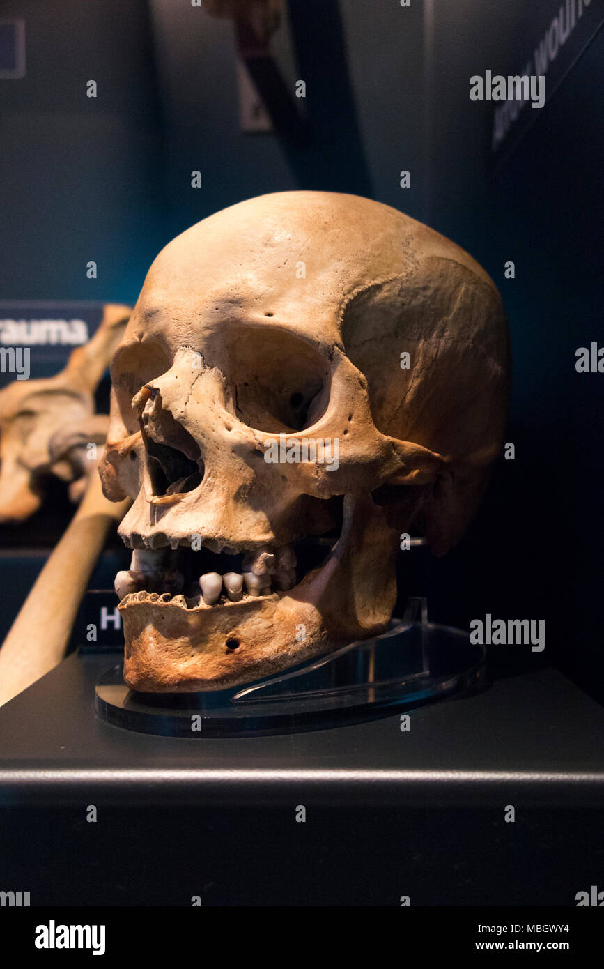 Cranio umano dal relitto della Mary Rose; nave da guerra di inglese Tudor marina del re Henry VIII Il Mary Rose Museum, Historic Dockyard, Portsmouth. Regno Unito Foto Stock