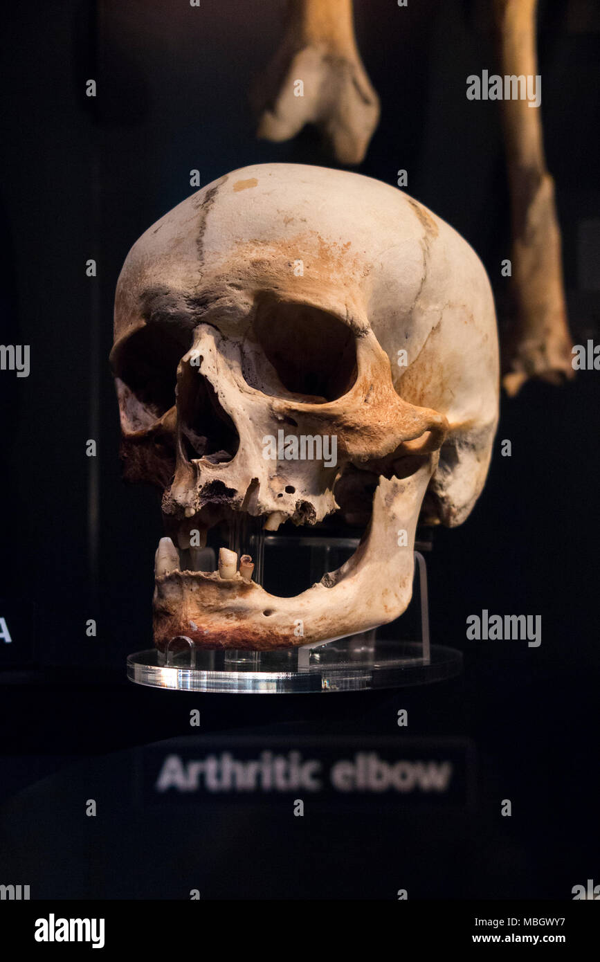 Cranio umano dal relitto della Mary Rose; nave da guerra di inglese Tudor marina del re Henry VIII Il Mary Rose Museum, Historic Dockyard, Portsmouth. Regno Unito Foto Stock