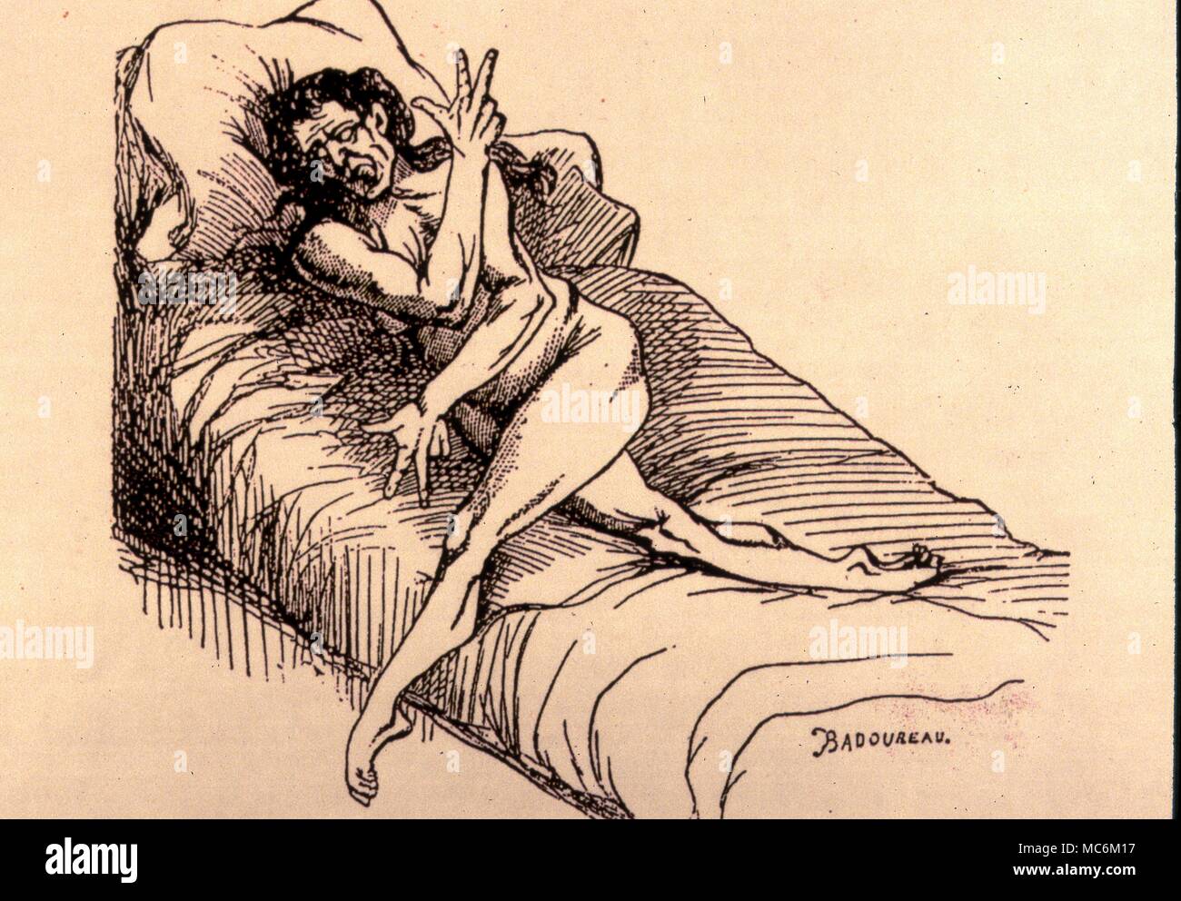 Ipnosi - Charcot. Disegno di un paziente isterica di J.M.Charcot (1825-1893), il francese ipnotizzatore. c.1874 Foto Stock