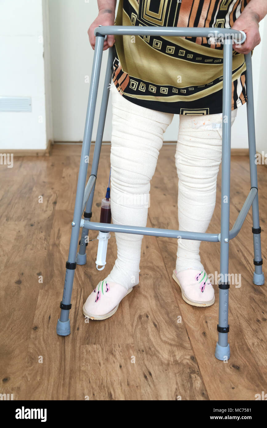 Una donna anziana dopo una operazione di endoprosthetics. Una donna cammina con un camminatore. Il sistema di drenaggio sul piede destro. Foto Stock