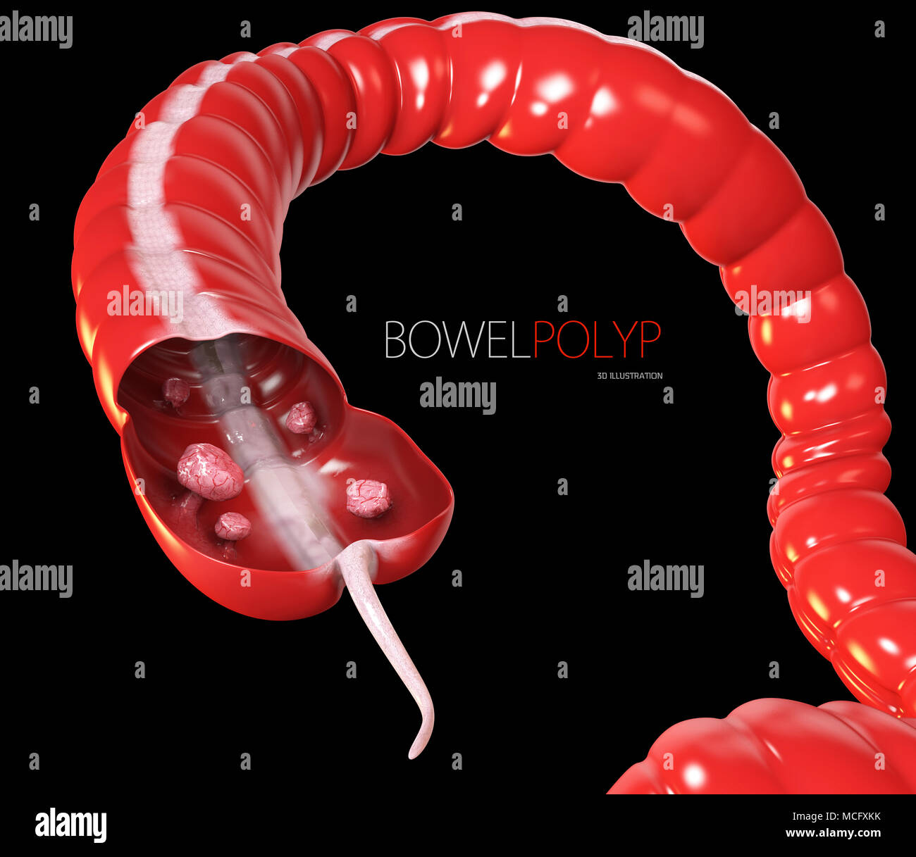 I polipi colon. 3d illustrazione- Polipo nell'intestino isolato nero Foto Stock