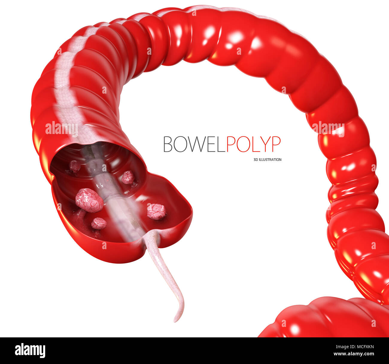 3d illustrazione dei polipi colon. Polipo nell'intestino. bianco isolato Foto Stock