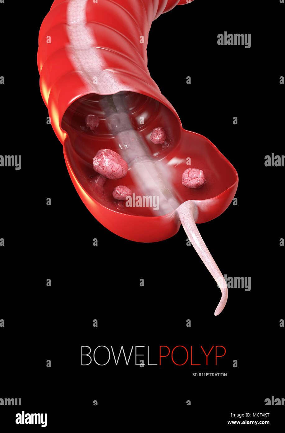 I polipi colon. 3d illustrazione- Polipo nell'intestino isolato nero Foto Stock