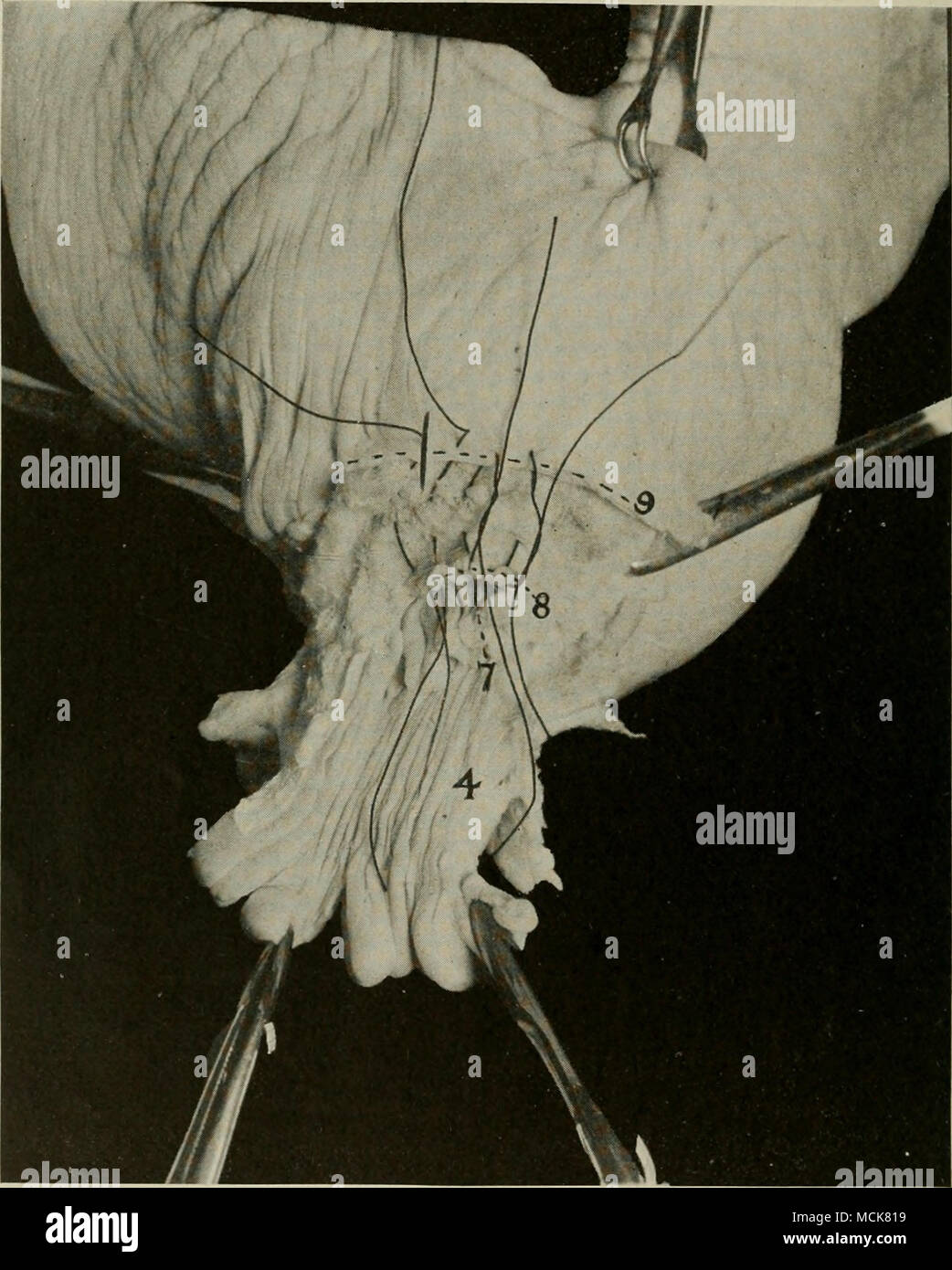 . I in fig. 202-circolare di amputazione della cervice Uteri. Mostra la ...