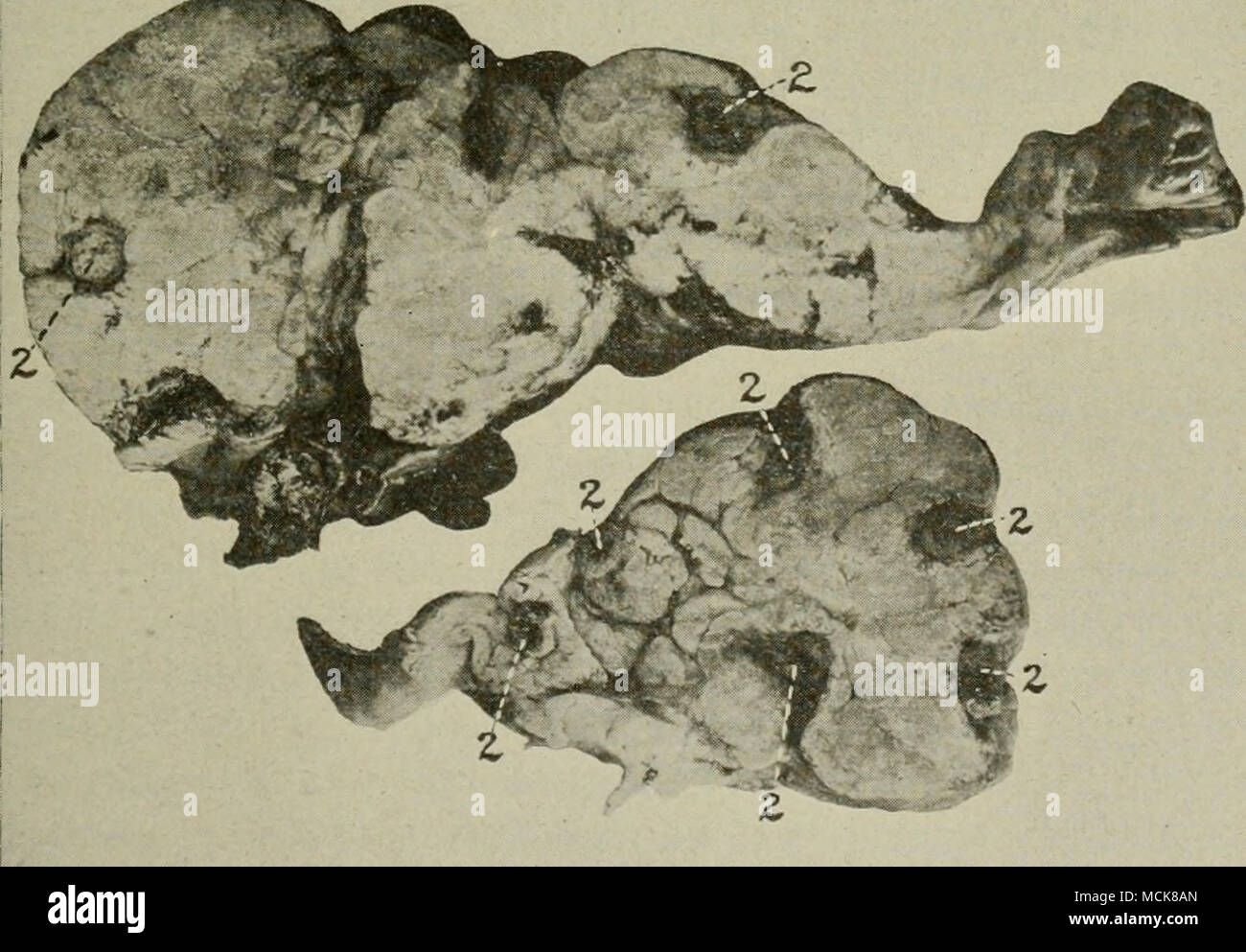 . Fig. 46. Lipoma del grasso mesenterica di intestino crasso. La mucca. / / /, Intestino crasso ; 2, 2, 2 sezioni trasversali delle anse di intestino crasso, circondato da tumore di grasso. Foto Stock