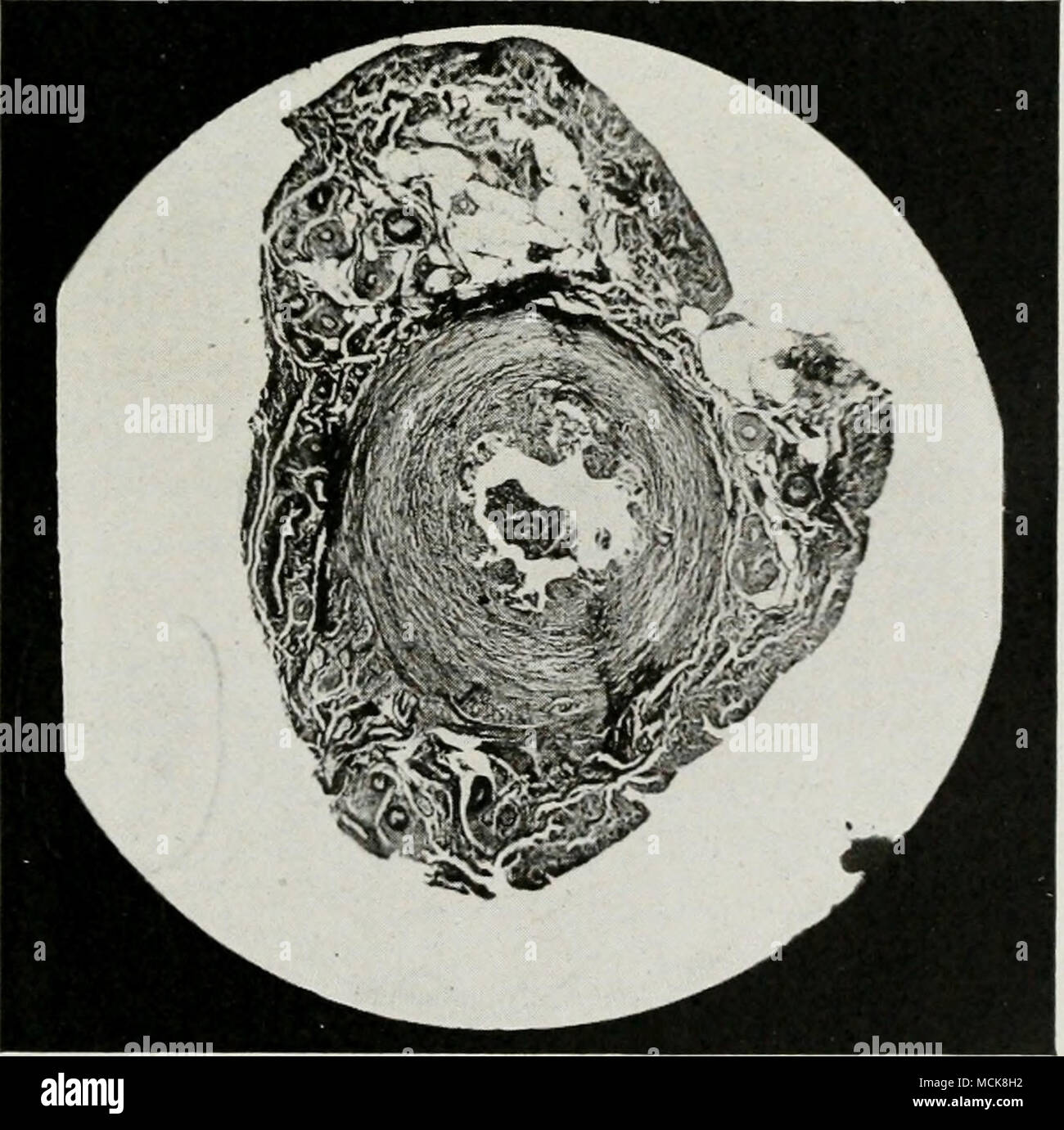 . Fig. 146-catarrali croniche salpingite, con un evidente edema della parete. Foto Stock