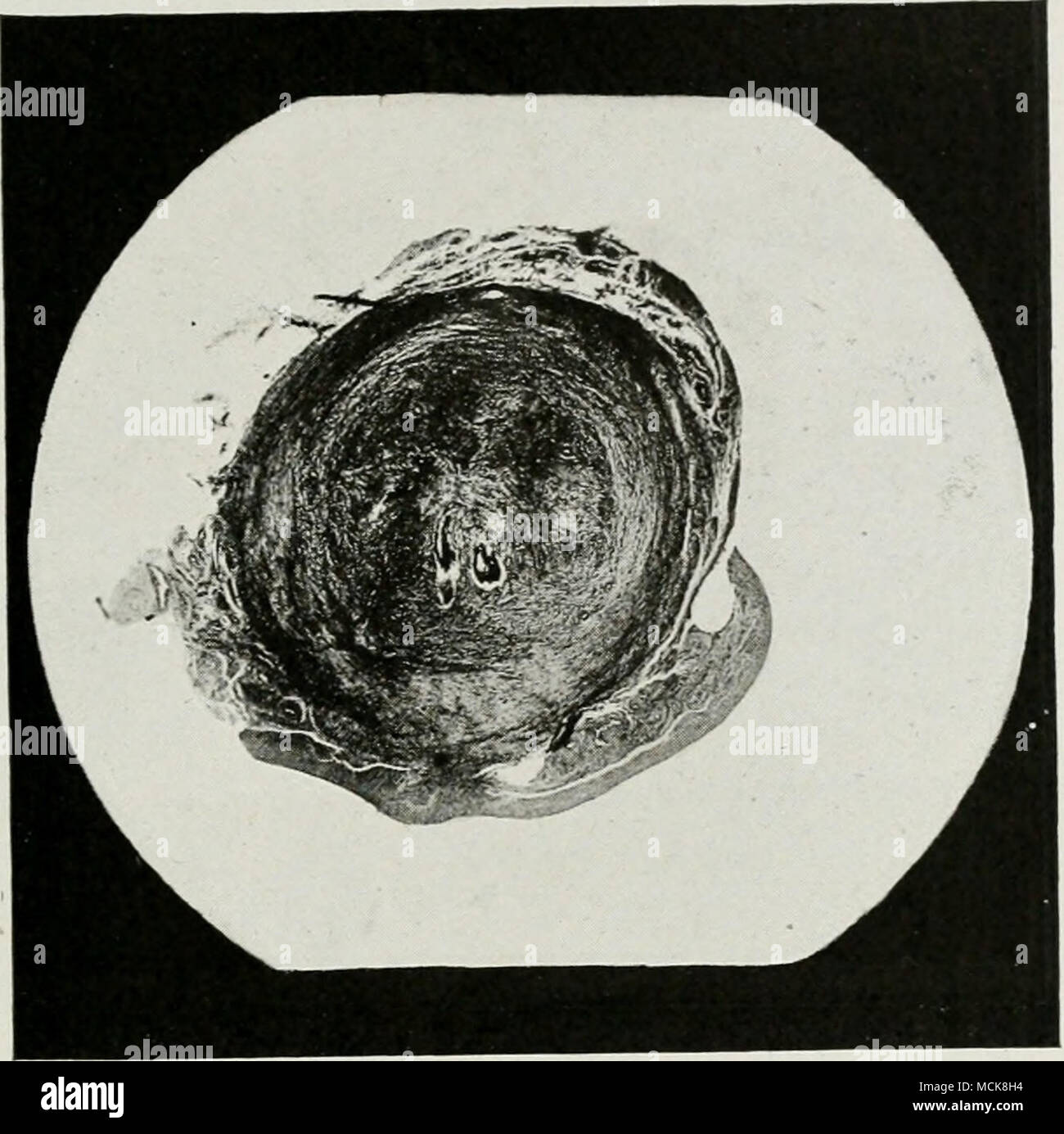 . Fig. 149-catarrali croniche salpingite. Con quasi totale occlusione. Vestigia del lume del tubo vengono mostrate da due piccole aree di nero delimitato da wliite. Foto Stock