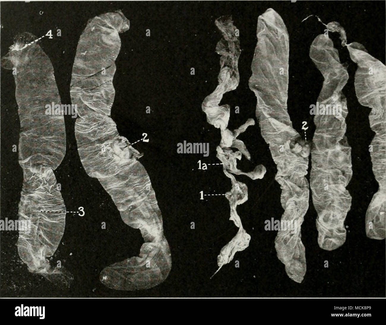 . Fig. 36-Necrotic Suggerimenti di Fetal Sacs, suina. /, La, Necrotic embrioni in totalmente necrosed sacs fetale ; 2, 2, normale embrioni entro amnion, il allantois avente stato aperto ; 7, punta necrotico della allantois. gonadotropina fasci costituiti da pareti capillari con un singolo epi- thelial strato, mentre il corrispondente cripta materna con- sists anche di anse capillari con un singolo, delicato, lo strato epiteliale. I monitor fetali e materni rimangono capillari perma- nently separati e due delicati strati epiteliali perma- nently separare la materna dal sangue fetale. Tutti i nu- triment e prodotti di scarto excha Foto Stock