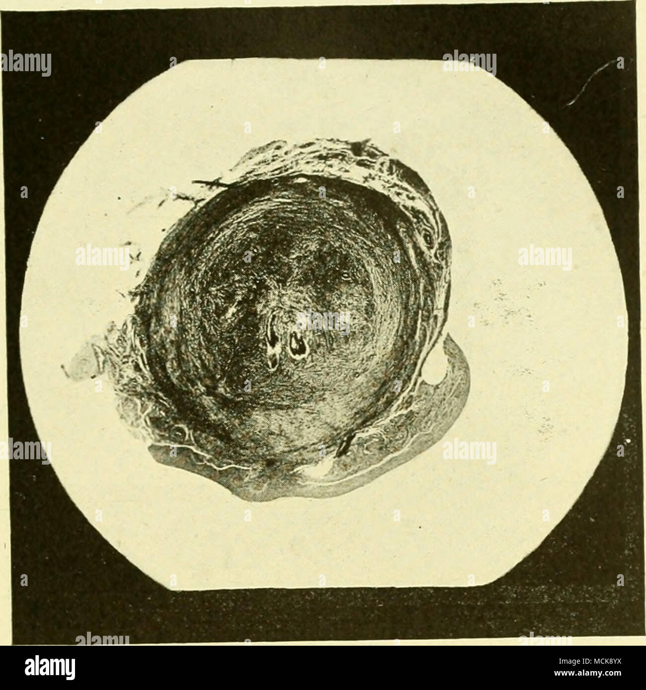 . Fig. 149-catarrali croniche salpingite. Con quasi totale occlusione. Vestigia del lume del tubo vengono mostrate da due piccole aree di nero delimitato da bianco. Foto Stock