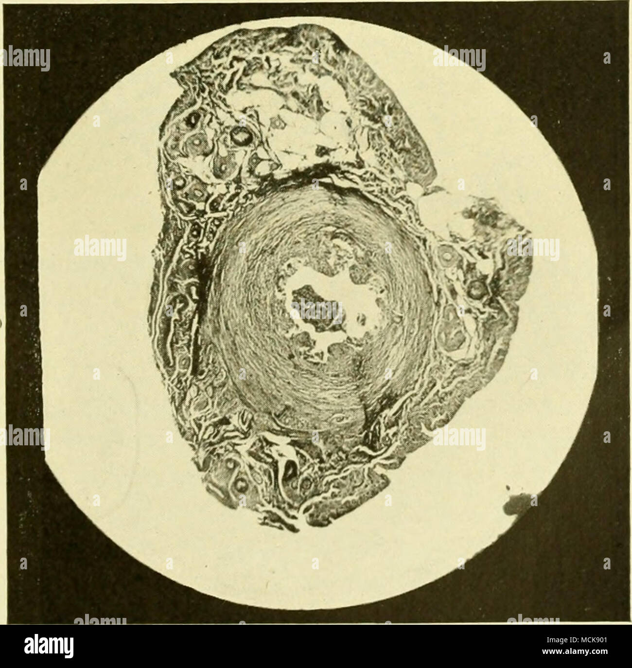 . Fig. 146-catarrali croniche salpingite, con un evidente edema della parete. Foto Stock