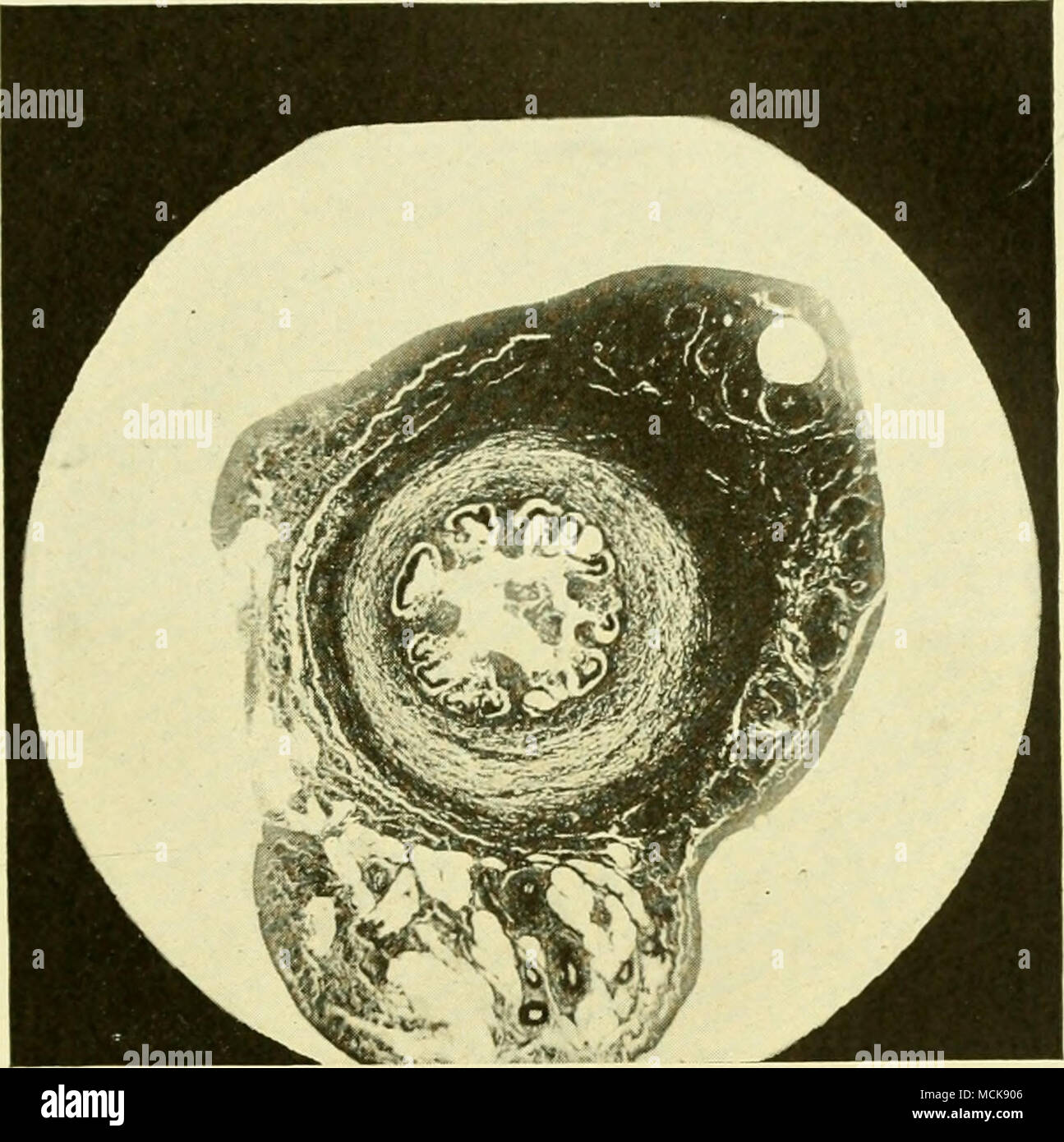 . Fig. 145-catarrali croniche salpingite, mostrando l'epitelio in procinto di essere Cast Off ed edema della parete. Foto Stock