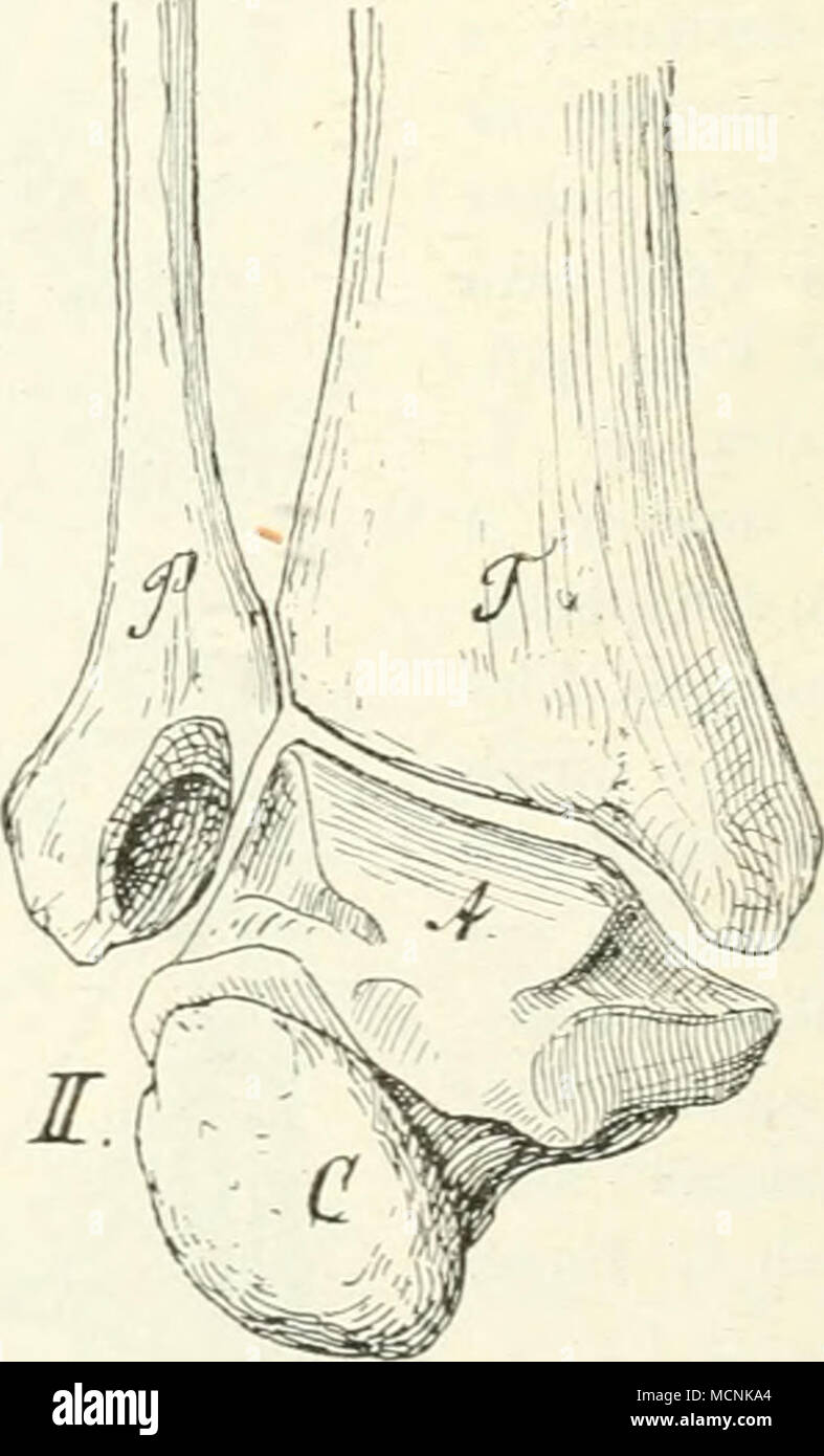 . Fig. .563. Ho Fußgelenk vom Menschen, II vom Gorilla; nach Topinard. T Tibia; P Fibula; un astragalo; C Calcagno. menschlicher, als liei Hylobates durch größoie Breite der Ilia. die konkav ventrale sind und durch gnißere' Weite und der Kürze Beckenhöhle. Die Hinterextremität endet in einem anatomisch echten Fuß. der. oberflächlich Foto Stock