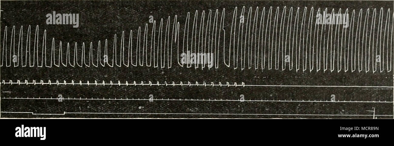 . Fig. 318. Rhythmische Reizimg der Kammer des Froschherzens. Nach F. B. Hof mann, un, Reizung des linken Vagus blutdurchströmten am Herzen; b, dasselbe 5 Minuten nach Verbluten dem des Herzens; c, dasselbe 35 Minuten später. Von links nach rechts zu lesen. ganz fehlt, um bedeutend zuzunehmen, wenn sich der Zustand des Herzens verschlechtert (vgl. Fig. 318). In diesem Zusammenhange noch ist die Frage nach dem direkten etwaigen chronotropen Einfluß des Vagus auf die Herzkammer des Frosches zu erörtern. Wenn man am Froschherzen den zentralen Stumpf der freipräparierten Scheidewandnerven reizt, così Foto Stock