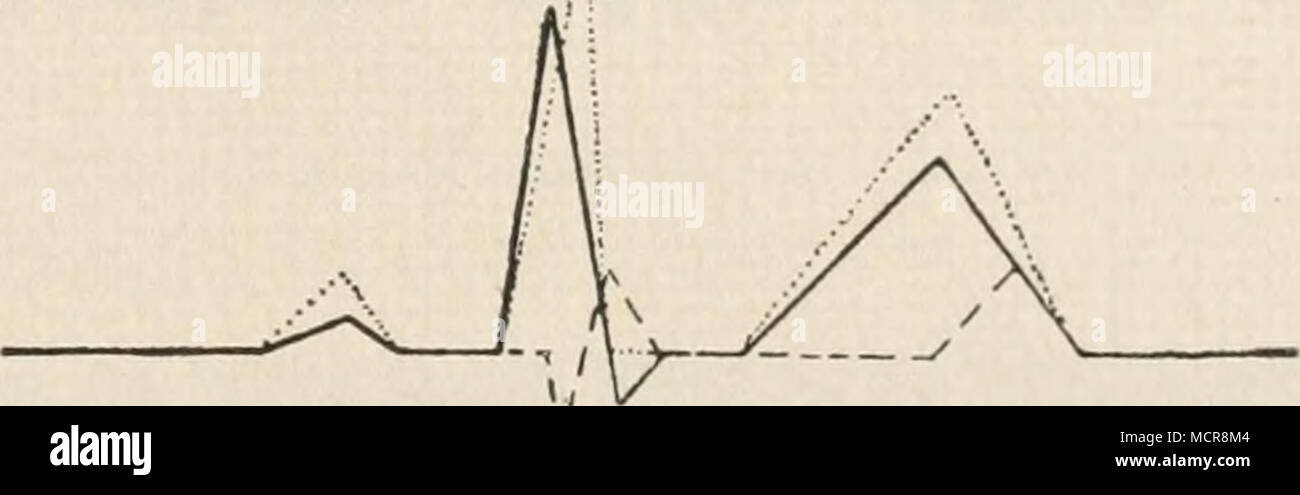 . Fig. 235. Verschiedene Ableitungsweisen des Elektrokardiogramms. Nach Kraus und Nicolai. Fig. 236. Schematische Darstellung des menschlichen Elektrokardiogramms bei verschiedener Ableitungs- weise. Nach Kahn. , Ableitung I; , Ableitung II; , Ableitung III. schiedenen Ableitungsweisen nicht in identische Phasen der Herzperioden ein- treffen. Kahn2, der diese Angaben von Einthoven bestätigt, teilt unter anderem drei übereinander gepauste Elektrokardiogramme von genau gleich langer Dauer mit, welche bei den genannten Ableitungsweisen un einer und derselben Versuchs- persona unmittelbar nacheinan Foto Stock