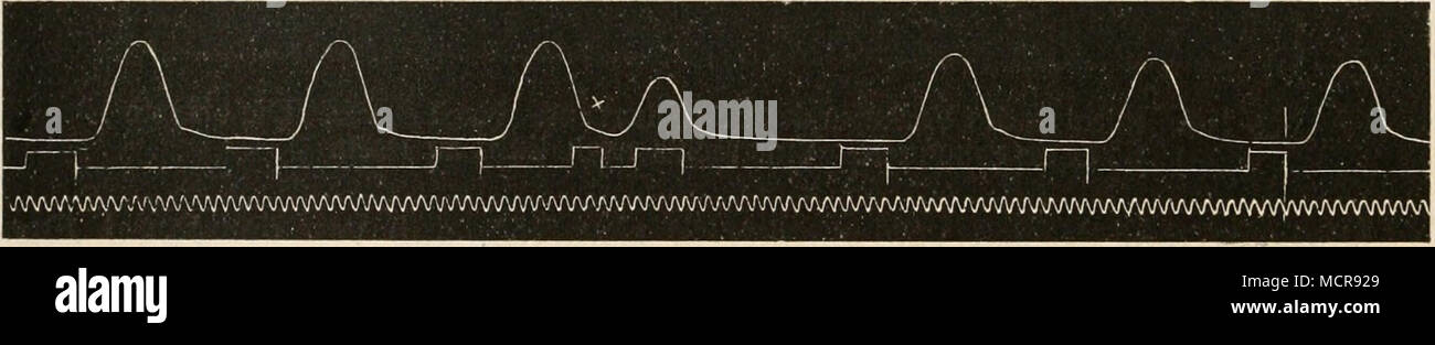 . Fig. 188. Rhythmische Reizung der isolierten Spitze des Froschherzens. Nach Engelmann. Von links nach rechts zu lesen. Erklärung im testo. Wenn der Venensinus des Froschherzens lokal abgekühlt wird, verlangsamt sich der Rhythmus des Herzens ganzen, auch der der Kammer, obgleich diese von der Abkühlung gar nicht getroffen wird. Wegen des jetzt stattfindenden verhältnismäßig langsamen Verlaufs der Kammerkontraktionen läßt sich nun durch direkte Reizung der Kammer eine Extrasystole ohne kompensatorische pausa zwischen zwei normalen Kontraktionen einschalten (Trendelenburgz). Dasselbe ist am vera Foto Stock