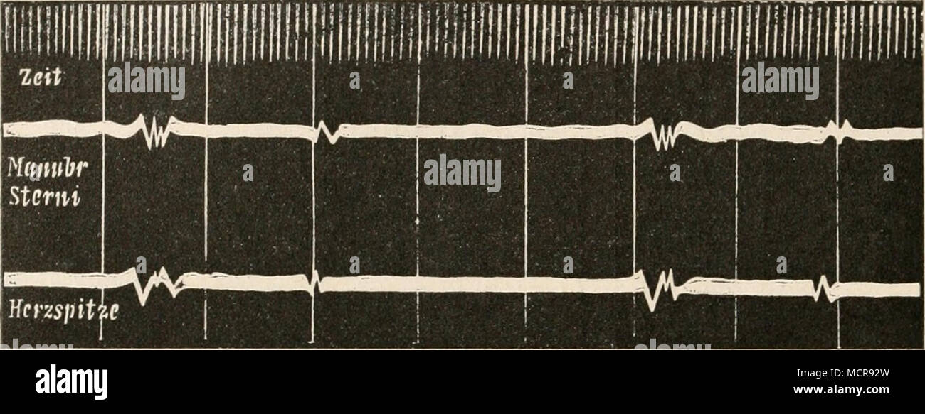. Fig. 37. Gleichzeitig registrierte Herztöne am manubrio sterni und an der Herzspitze. Weber und Wirth. Von links nach rechts zu lesen. Nach Ob überhaupt die nähere analizzare der betreffenden Schwingungen Resultate von Bedeutung größerer ergeben können, kann noch nicht sicher entschieden werden. Im großen und ganzen dürften die bis jetzt gewonnenen Resultate kaum etwas mehr ergeben haben als eine ziemlich exakte Bestimmung der Zeit, wo die Herztöne beginnen und anche eine ziemlich befriedigende Bestimmung der Länge der Herzsystole.* Die Lage der Herztöne im Verhalten zu den anderen äußeren Aus Foto Stock