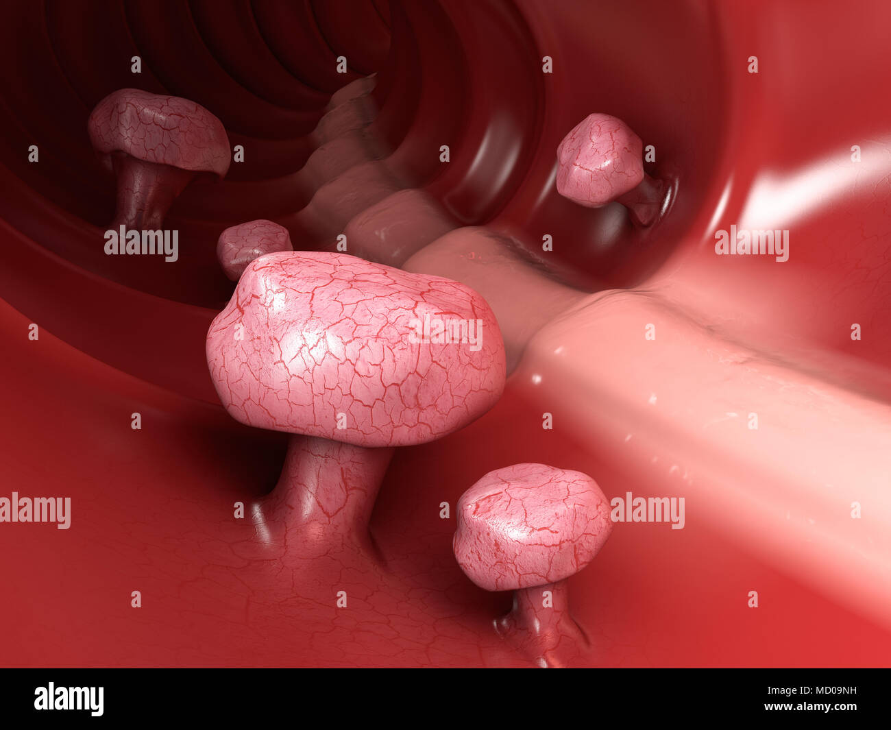 3d illustrazione dei polipi colon. Polipo nell'intestino Isolato bianco. Foto Stock
