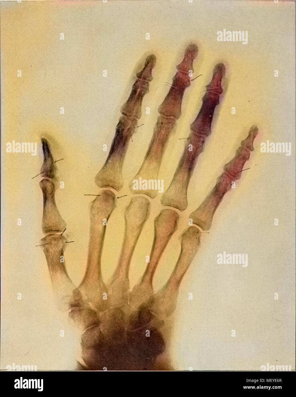 Early medical x ray immagine di una mano, mostrando artrite, 1909. La cortesia Internet Archive. Nota: l'immagine è stato colorizzato digitalmente usando un processo moderno. I colori possono non essere periodo-precisa. () Foto Stock
