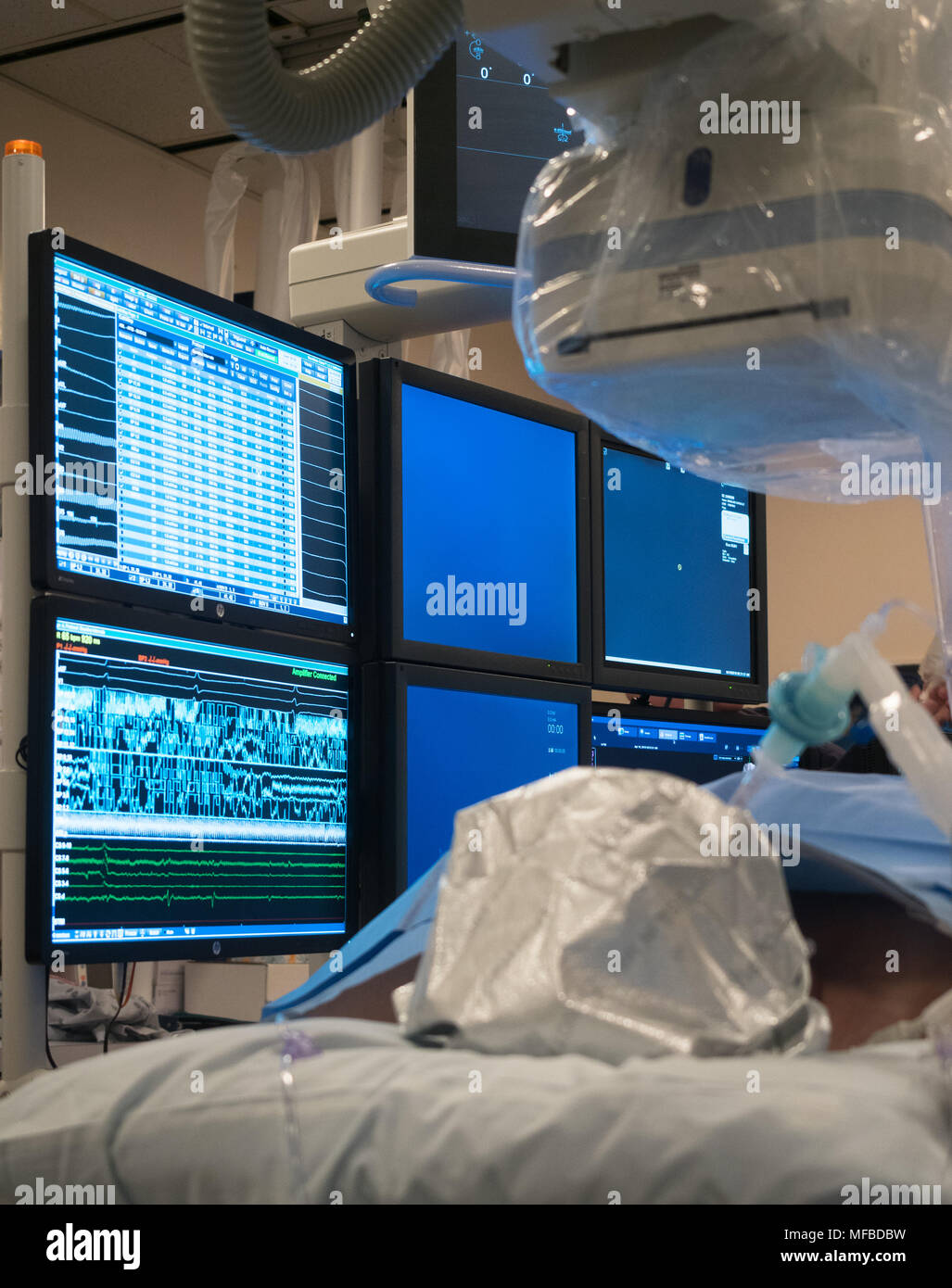 Un paziente anestetizzato indossando un argento tappo termico nel laboratorio di elettrofisiologia con una banca di monitor in background e una macchina a raggi x di cui sopra. Foto Stock
