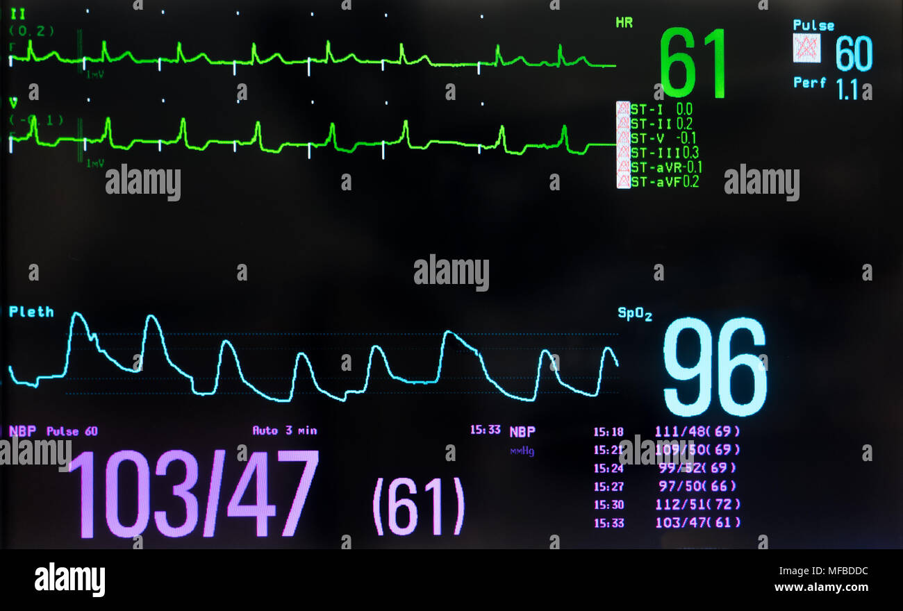 Monitor con schermo nero che mostra i picchi di stimolazione di un paziente stimolato il ritmo cardiaco in verde, la saturazione di ossigeno in azzurro e non invasiva di sangue in viola. Foto Stock