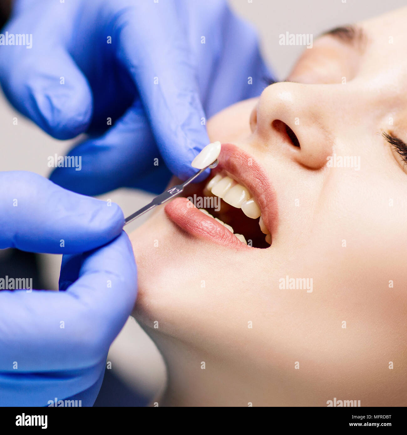 Denti del paziente in ombra con i campioni per il trattamento di sbianca. Foto Stock