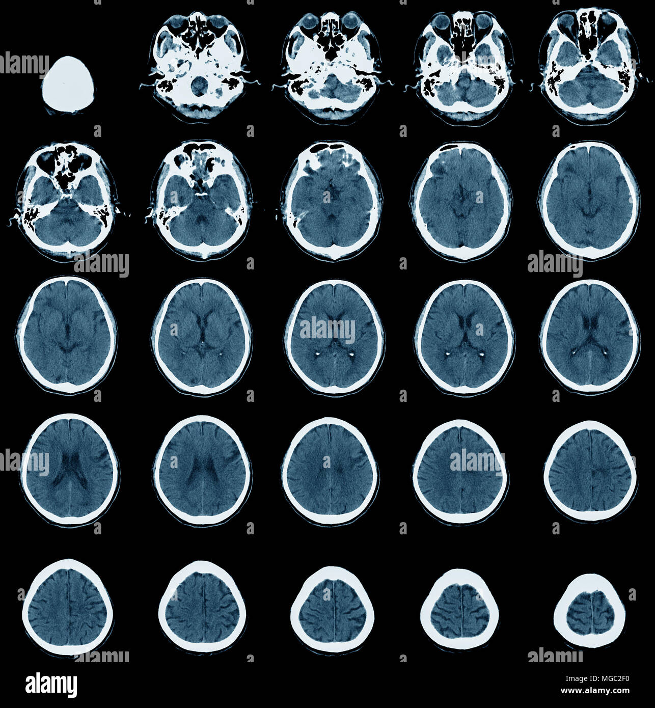 Immagine della scansione TC, x-ray computer del cranio Foto Stock
