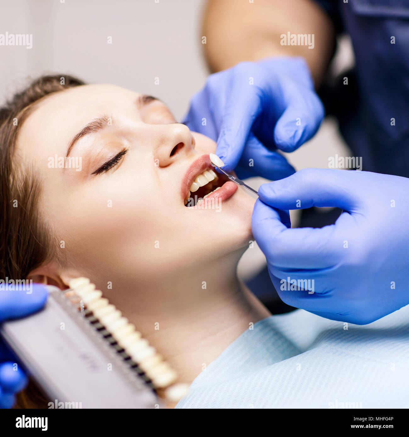 Denti del paziente in ombra con i campioni per il trattamento di sbianca. Foto Stock