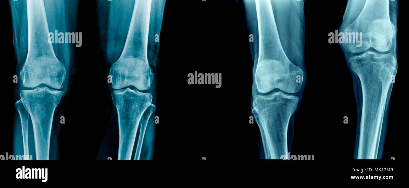 Raccolta di articolazione del ginocchio dolore x-ray set, alta qualità del ginocchio e della tibia e femore osso Foto Stock