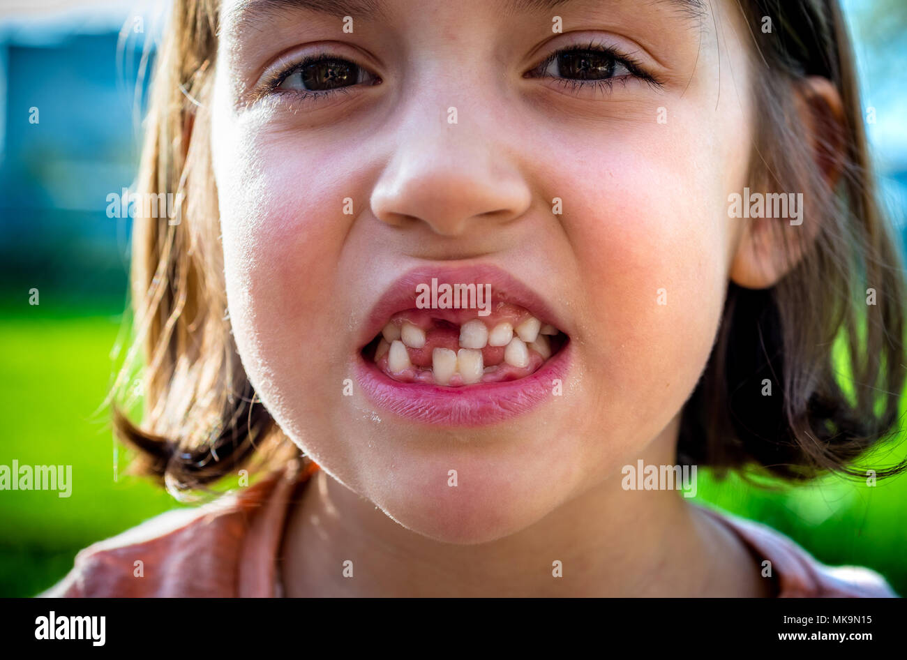Ritratto di bambino priva di denti mancanti ragazza latte e denti permanenti. Primo piano del giovane capretto con denti lacune e permanente in crescita i denti e le gengive sane p Foto Stock