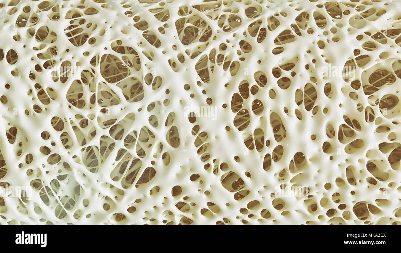 L'Osteoporosi avanzate -alta dettagli - Fase 4 - 3d rendering Foto Stock