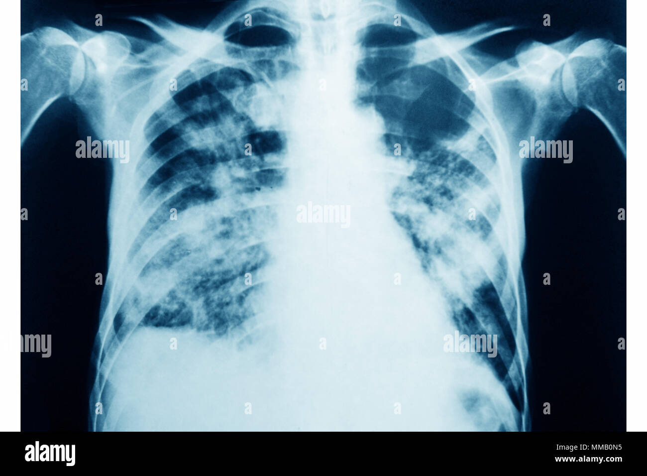 Polmonite da PNEUMOCYSTIS Foto Stock