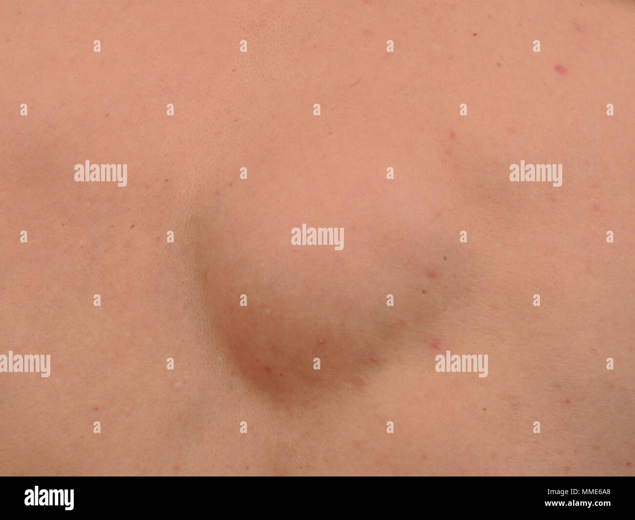 Fatty Lipoma Immagini e Fotos Stock - Alamy