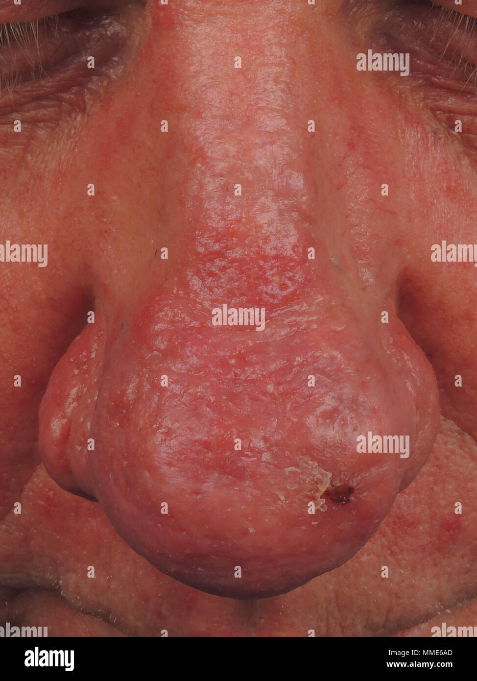 RHINOPHYMA Foto Stock