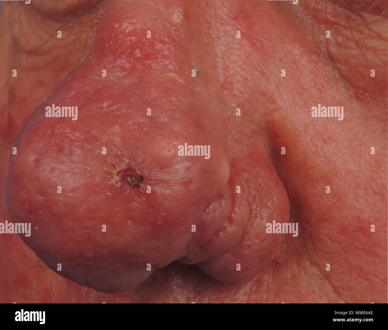 RHINOPHYMA Foto Stock