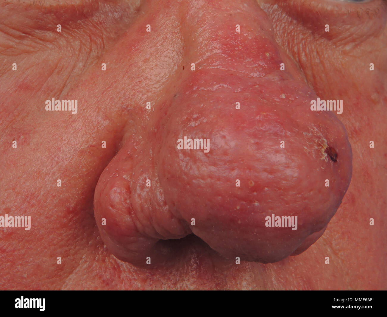 RHINOPHYMA Foto Stock
