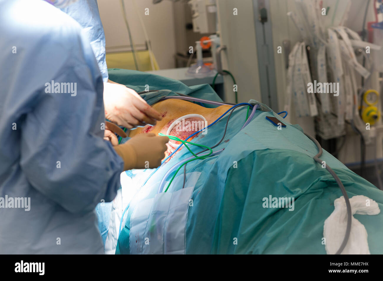 Trapianto di Rene Foto Stock