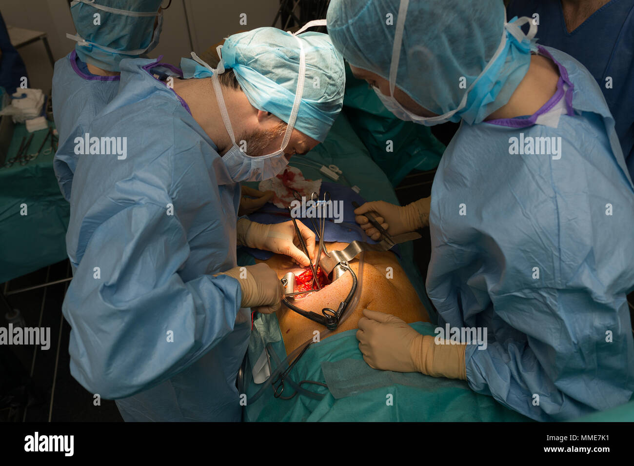 Trapianto di Rene Foto Stock