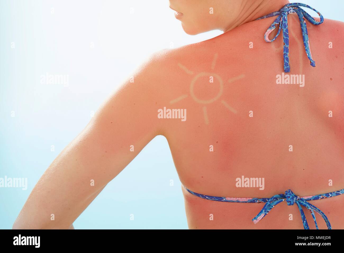 Modello rilasciato. Donna con la schiena bruciata dal sole e sun forma sulla spalla. Foto Stock