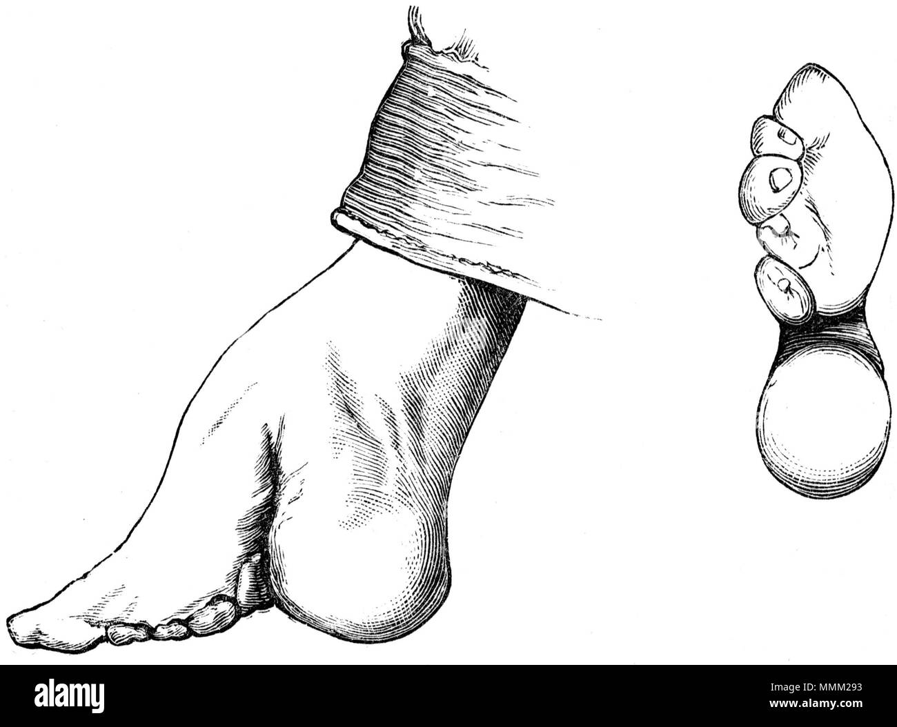 . Inglese: Fig. 15-donna cinese il piede, dall'interno. Fig. 16--suola di donna cinese il piede. (Dopo) una fotografia dal Dott. R. Jamieson. Il dott. Jamieson dice, "il quartiere alla moda di lunghezza per una signora cinese il piede è compresa tra 3 1/2 e 4 pollici, ma comparatibely alcuni genitori riescono ad arrestare la crescita in modo completamente. . 1 aprile 1880. William Henry fiore donna cinese il piede Foto Stock