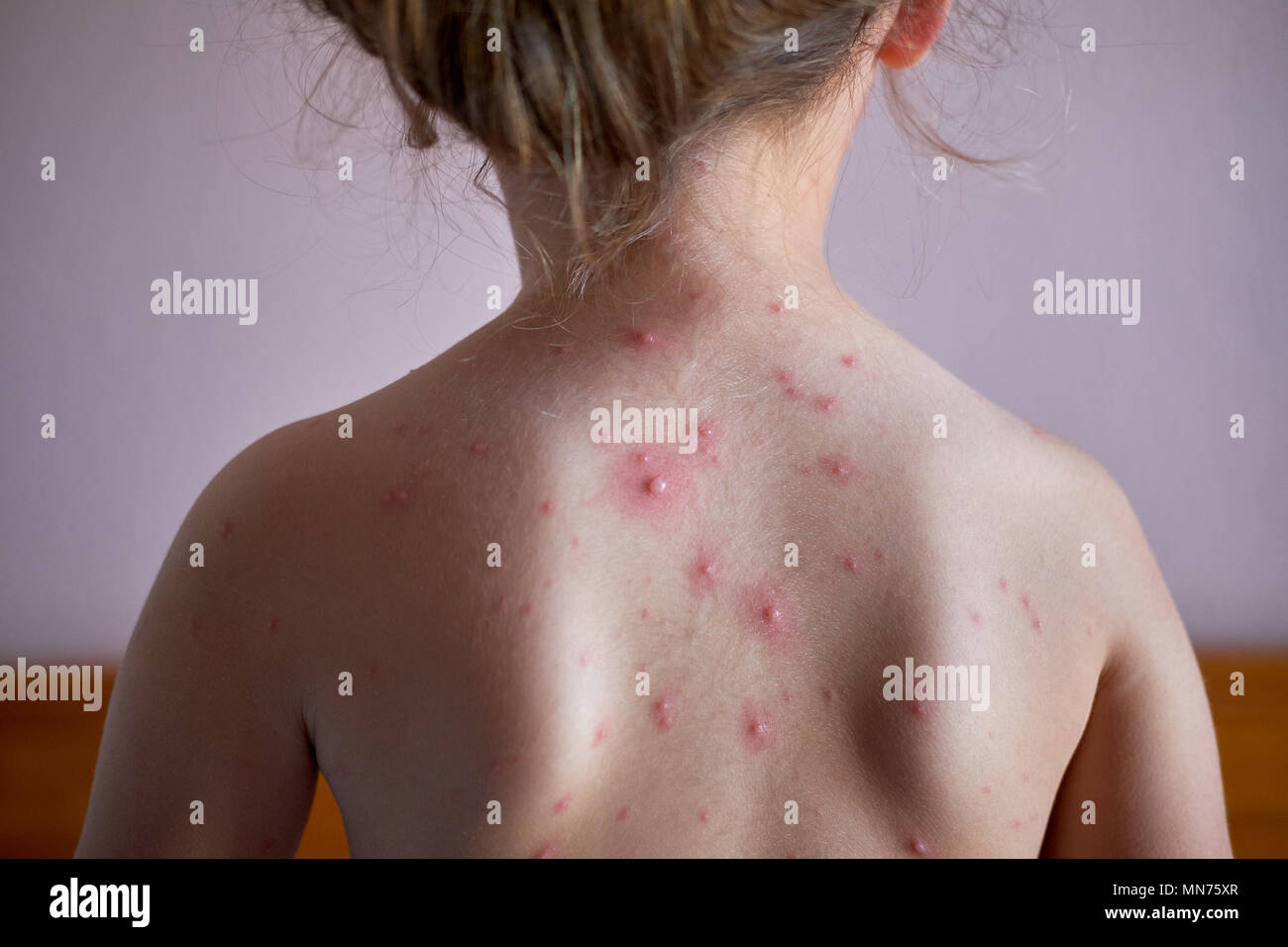 Bambina con la varicella sulla sua schiena Foto Stock