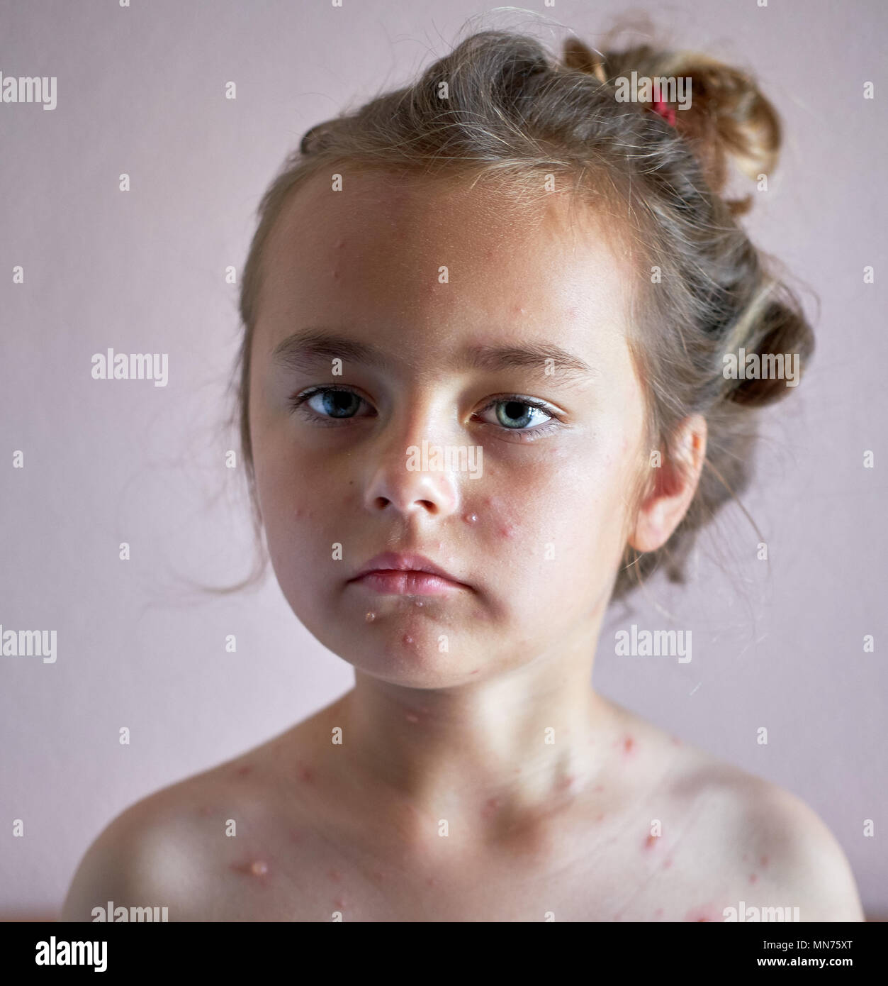 Ritratto di un grazioso 6 anni bambina con la varicella Foto Stock